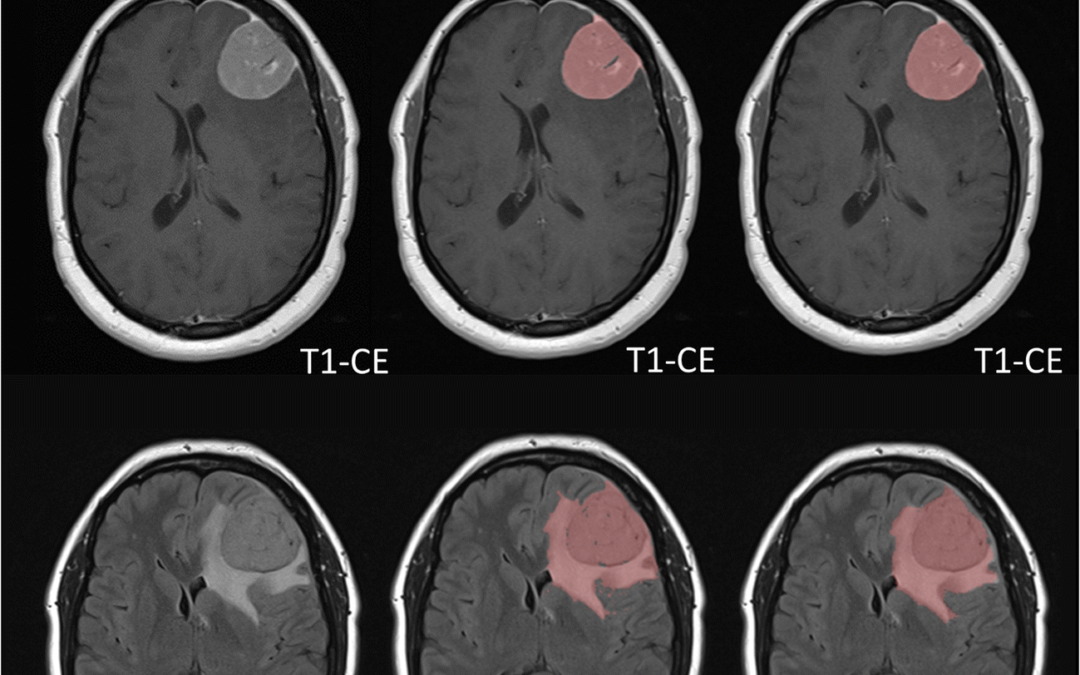 Using deep learning to detect and segment meningiomas