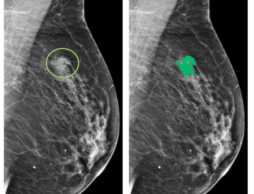 Breast cancer Ki-67 expression prediction by digital breast tomosynthesis radiomics features