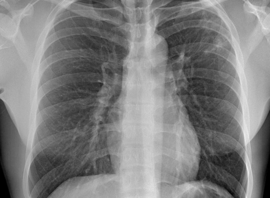 Deep learning–based automated detection algorithm for active pulmonary tuberculosis on chest radiographs: diagnostic performance in systematic screening of asymptomatic individuals