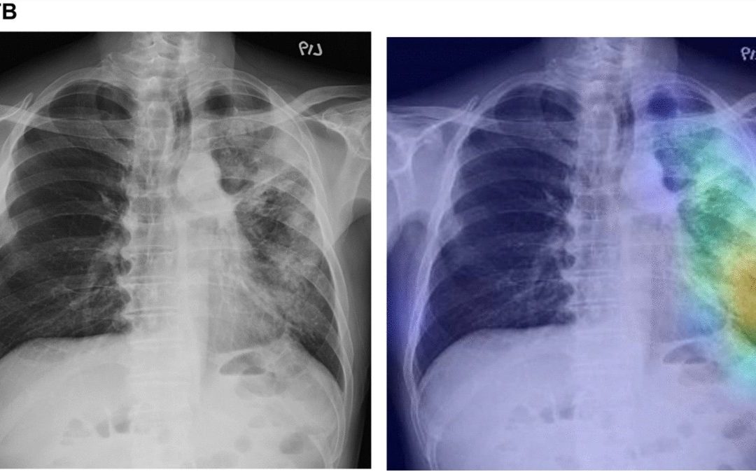 A deep learning model using chest X-ray to identify TB and NTM-LD patients