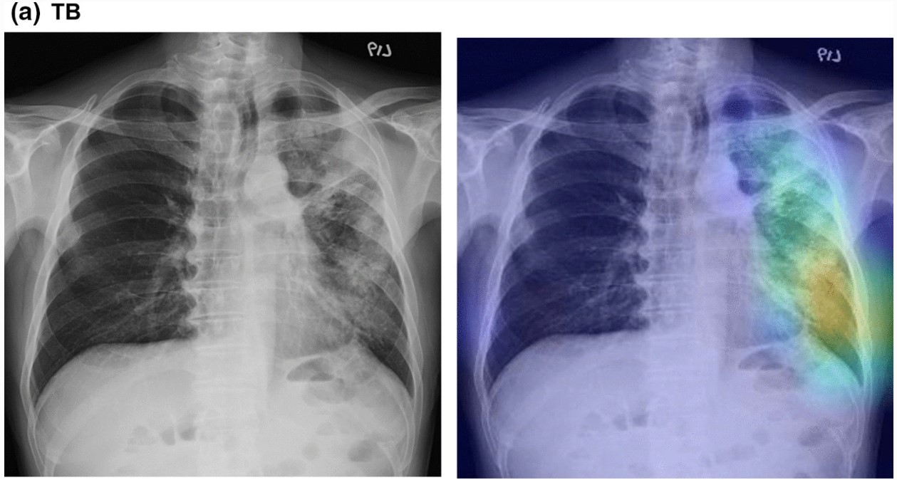 A deep learning model using chest X-ray to identify TB and NTM-LD patients