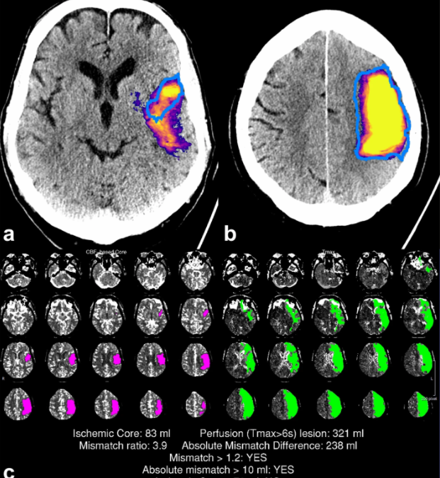 Evaluation of a CTA-based convolutional neural network for infarct volume prediction in anterior cerebral circulation ischaemic stroke