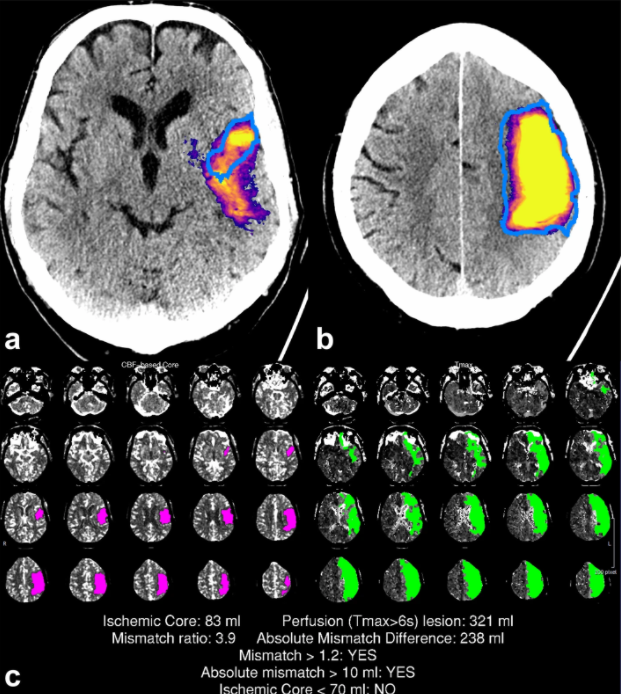 Evaluation of a CTA-based convolutional neural network for infarct volume prediction in anterior cerebral circulation ischaemic stroke