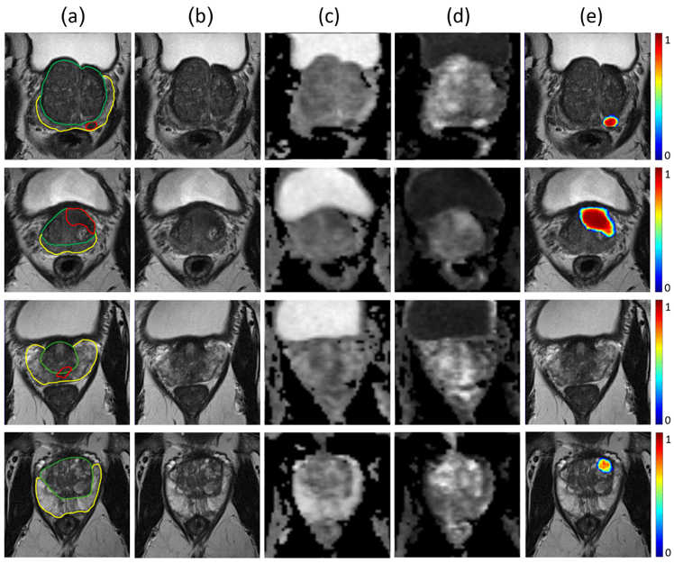 Deep learning–assisted prostate cancer detection on bi-parametric MRI: minimum training data size requirements and effect of prior knowledge