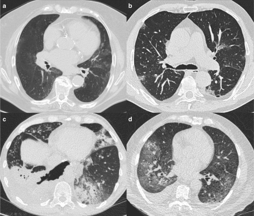 Commercial AI solutions in detecting COVID‐19 pneumonia in chest CT: not yet ready for clinical implementation?