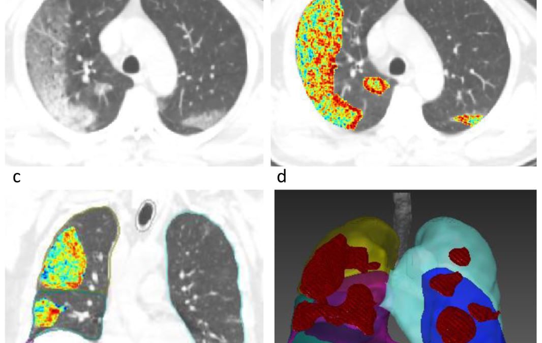 Development and multicenter validation of a CT-based radiomics signature for predicting severe COVID-19 pneumonia