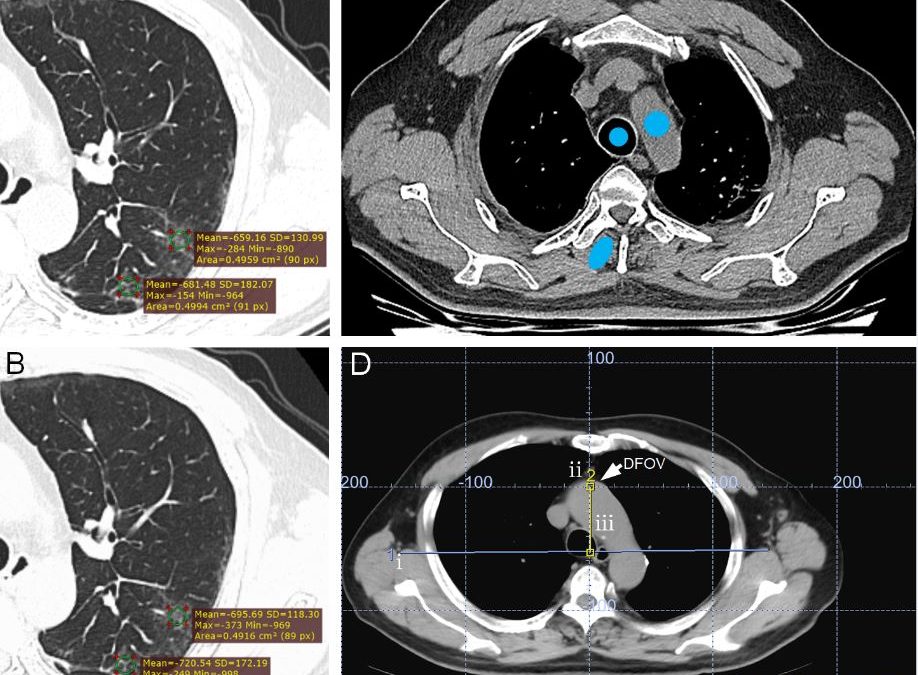 A comparison between manual and artificial intelligence–based automatic positioning in CT imaging for COVID-19 patients