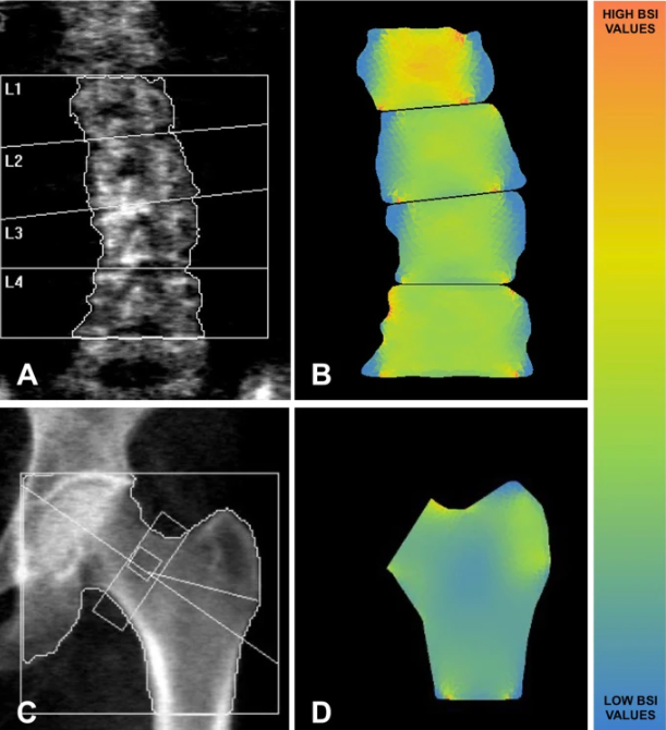 Bone Strain Index predicts fragility fracture in osteoporotic women