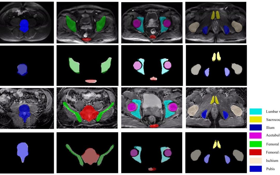 Fully automated pelvic bone segmentation in multiparametric MRI using a 3D convolutional neural network