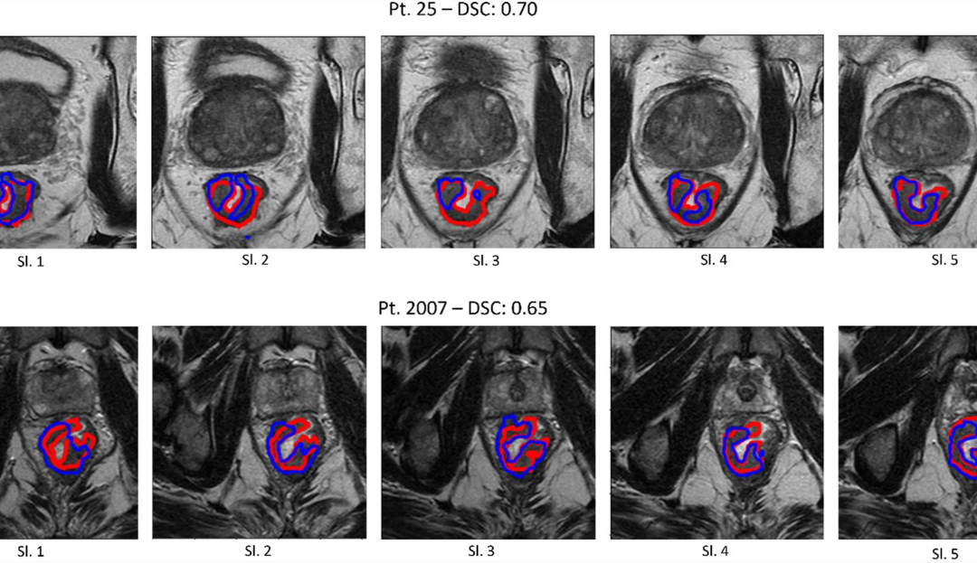 MRI-based radiomics to predict response in locally advanced rectal cancer