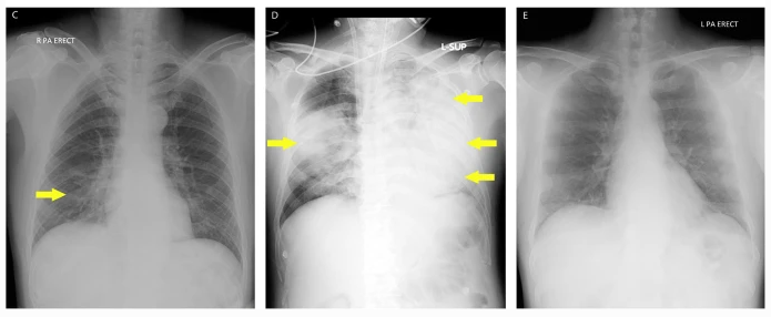 AI system for detecting COVID-19 on chest radiographs in symptomatic patients