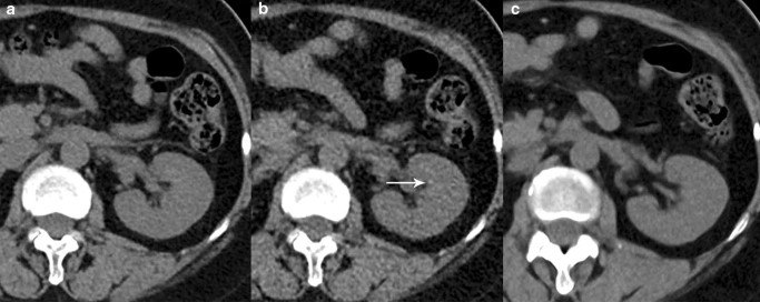 Application of deep learning reconstruction in the diagnosis of renal calculi