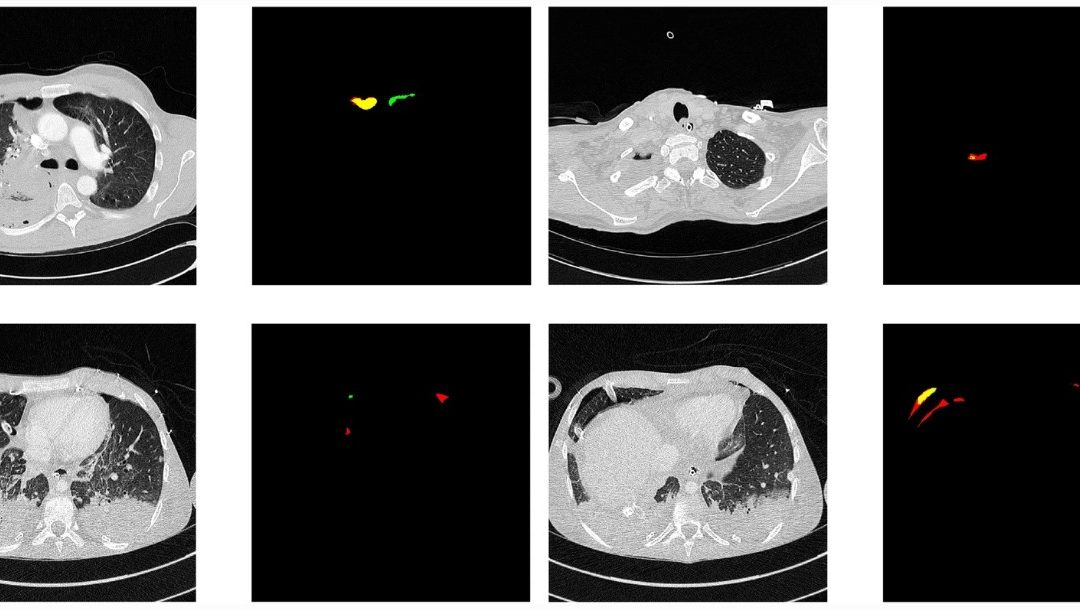 Deep learning detection and quantification of pneumothorax in heterogeneous routine chest computed tomography