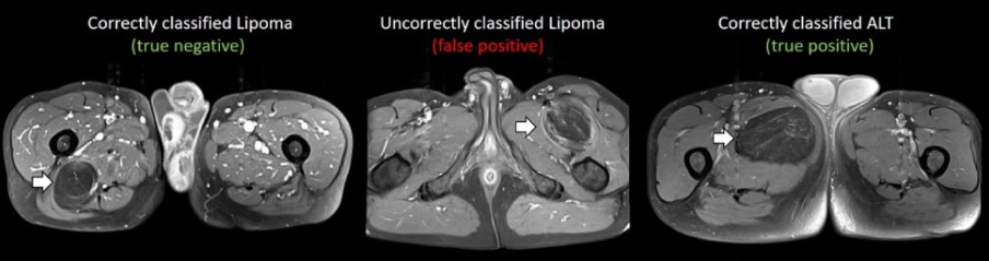 Prediction of lipomatous soft tissue malignancy on MRI