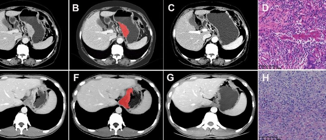 Enhanced CT-based radiomics predicts pathological complete response for advanced adenocarcinoma