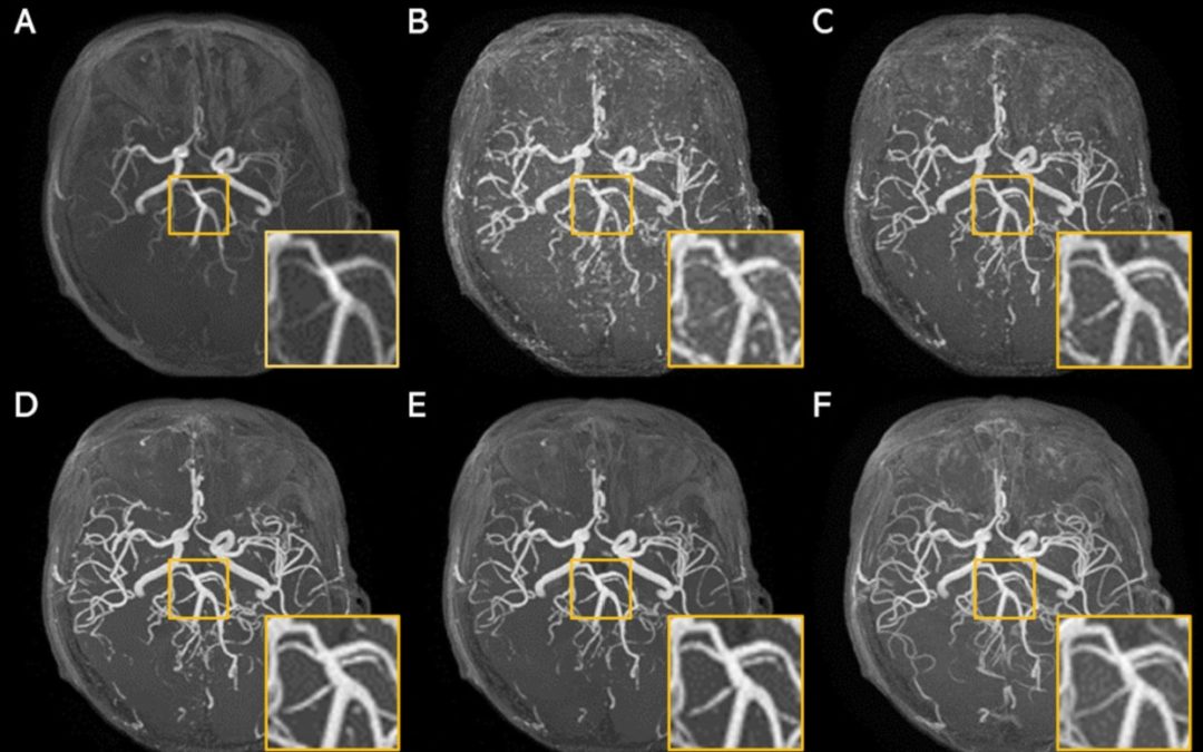 Super-resolution application of GAN on brain time-of-flight MR angiography