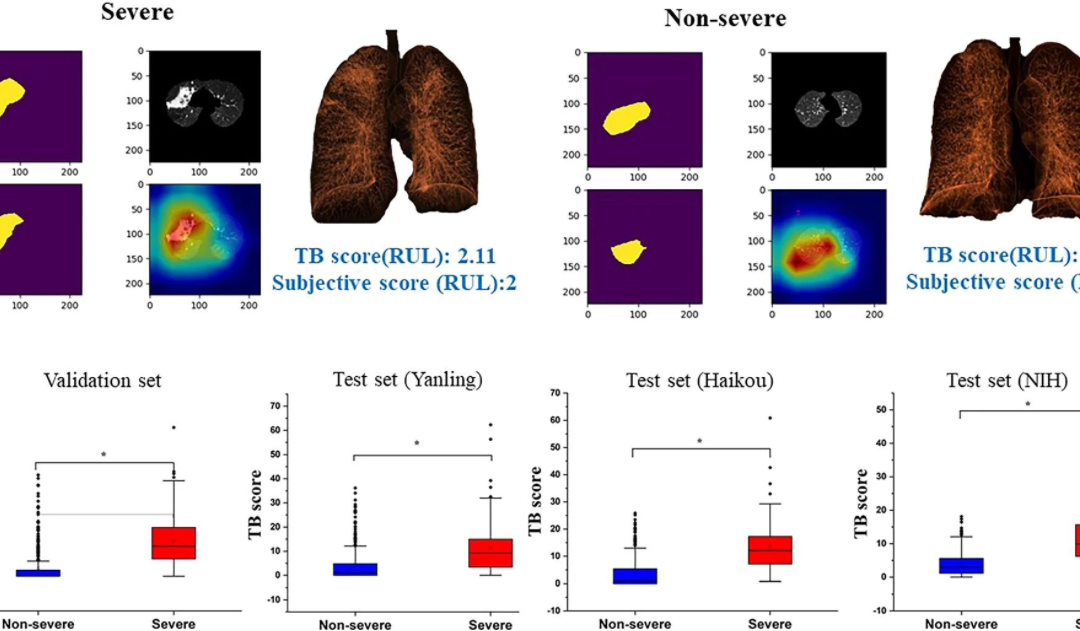 A fully automatic artificial intelligence–based CT image analysis system for accurate detection, diagnosis, and quantitative severity evaluation of pulmonary tuberculosis