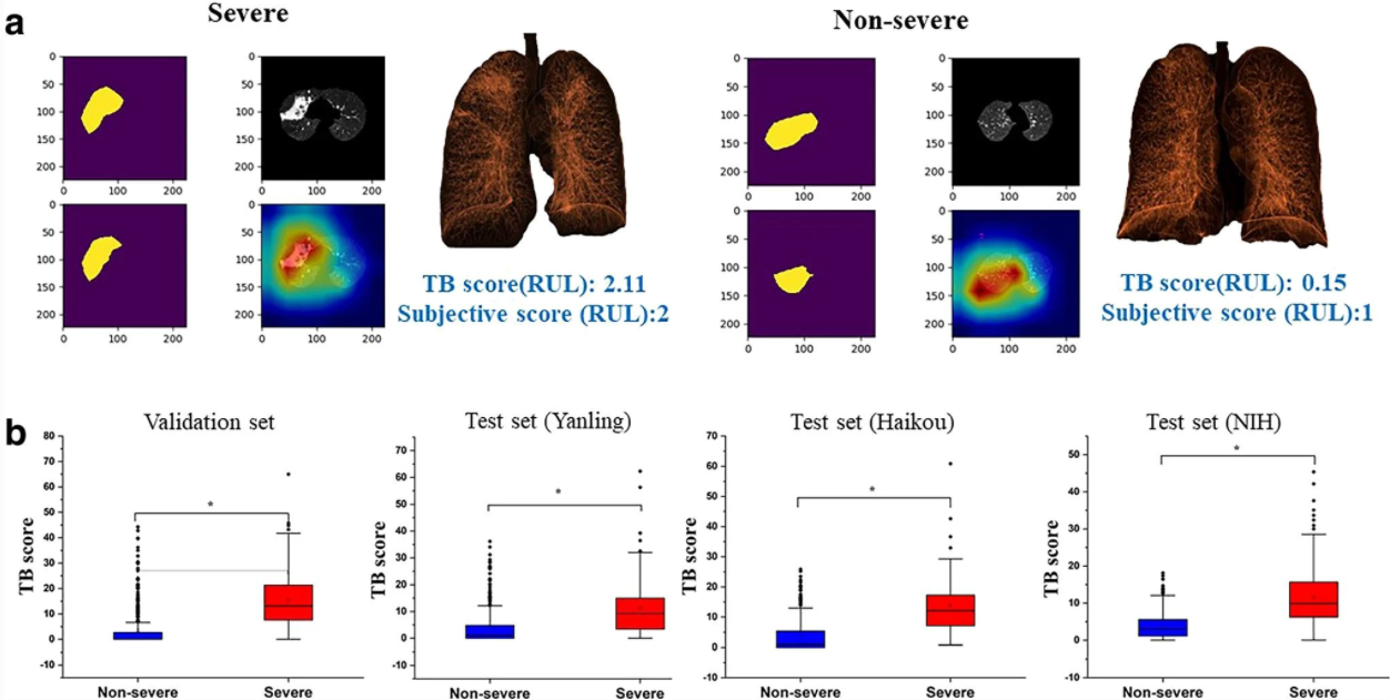 A fully automatic artificial intelligence–based CT image analysis system for accurate detection, diagnosis, and quantitative severity evaluation of pulmonary tuberculosis