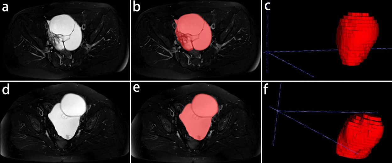 T2-weighted MRI-based radiomics discriminati between benign and borderline epithelial ovarian tumors
