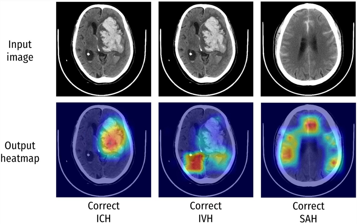 Evaluation of techniques to improve a deep learning algorithm for the automatic detection of intracranial haemorrhage on CT head imaging