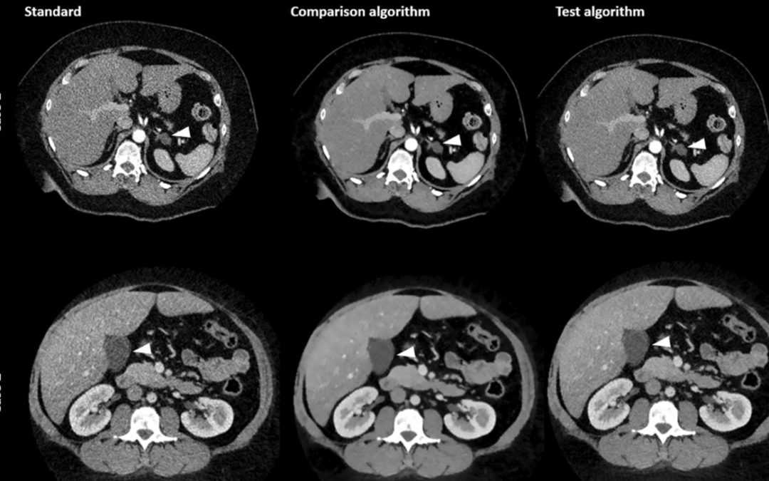 Evaluating the impact of a novel denoising algorithm on image quality in dual-energy abdominal CT of obese patients