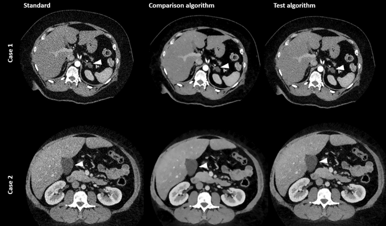 Evaluating the impact of a novel denoising algorithm on image quality in dual-energy abdominal CT of obese patients