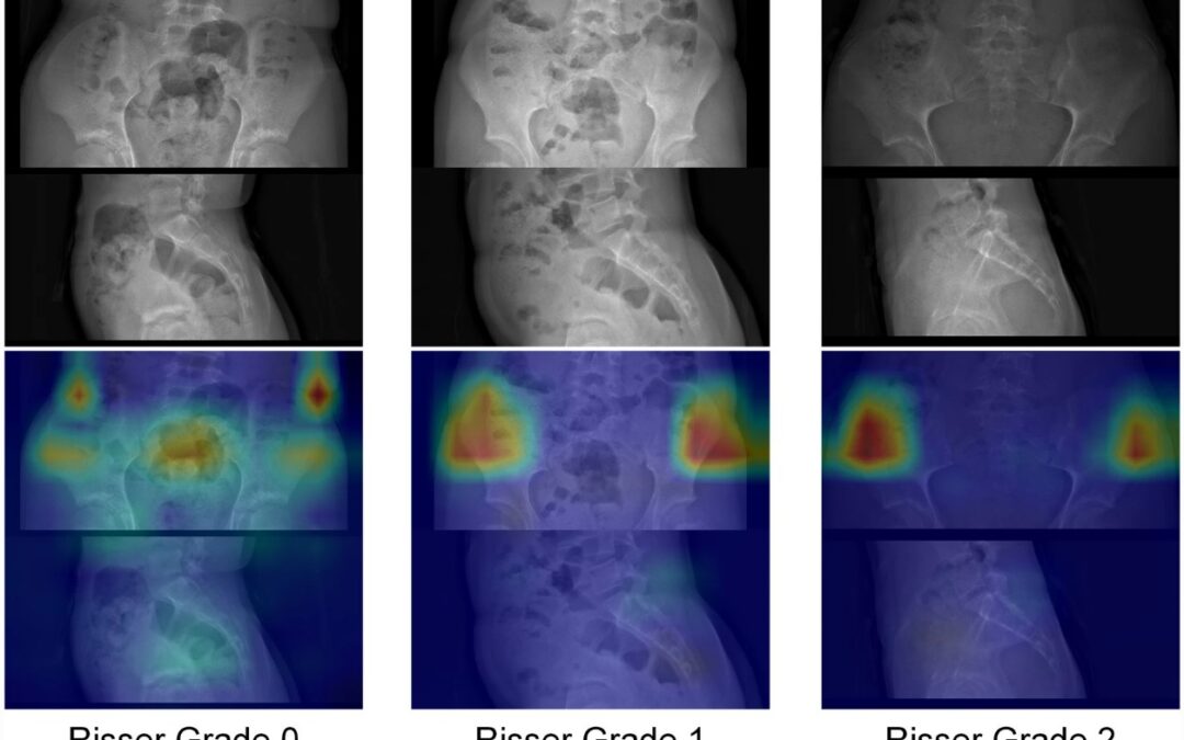 Deep learning–based identification of spine growth potential on EOS radiographs