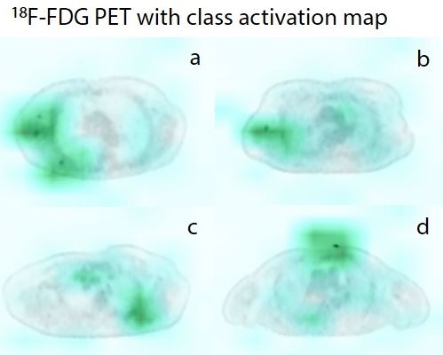 Artificial intelligence for detecting small FDG-positive lung nodules in digital PET/CT