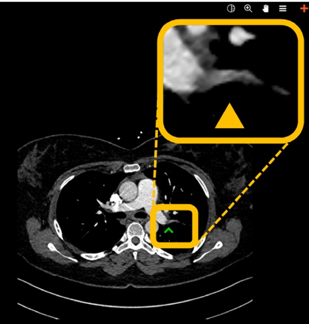 Automated detection of pulmonary embolism in CT pulmonary angiograms using an AI-powered algorithm