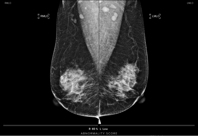 Differentiating lesions presenting as calcifications with AI