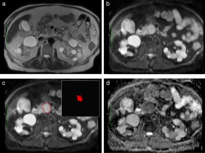 A machine learning model for the prediction of survival and tumor subtype in pancreatic ductal adenocarcinoma from preoperative diffusion-weighted imaging