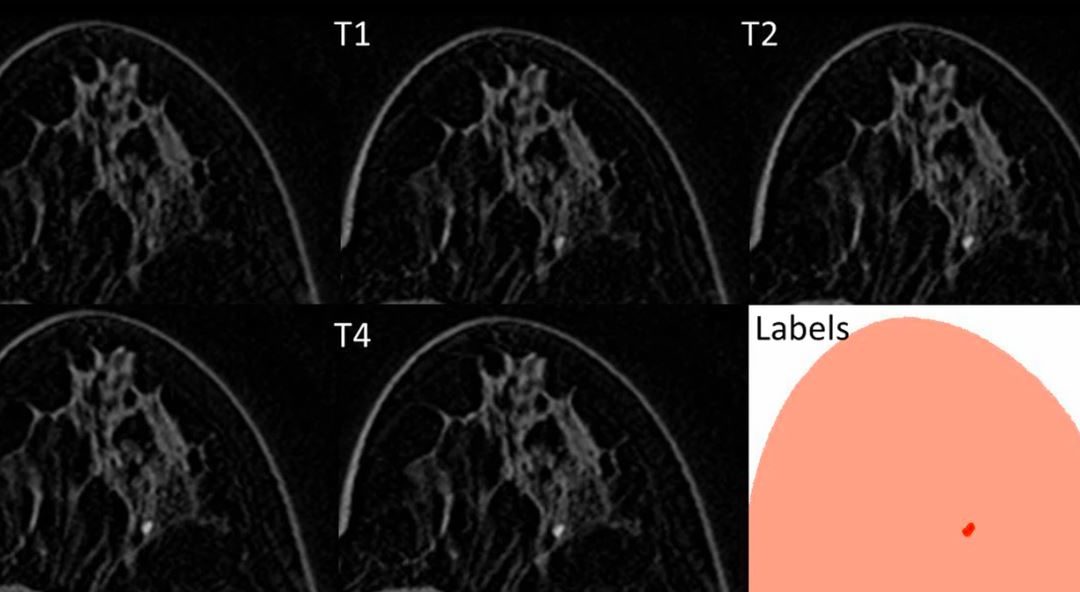 A machine learning approach for differentiating malignant from benign enhancing foci on breast MRI
